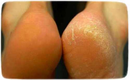 как смягчить трещины на пятках естественным способом с помощью этих средств